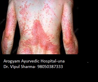 AROGYAM PURE HERBS KIT FOR PSORIASIS image